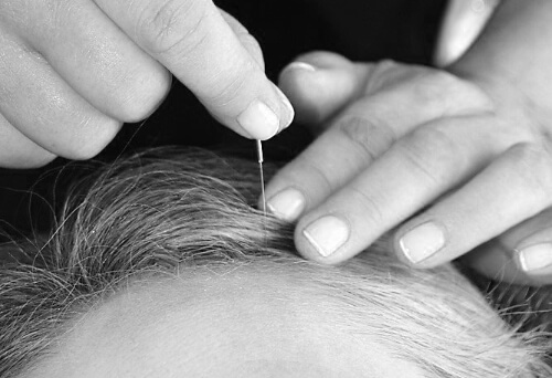 Acupuncture needle being inserted into scalp